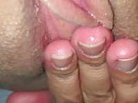 Beckis gaping hole ( cervix view)